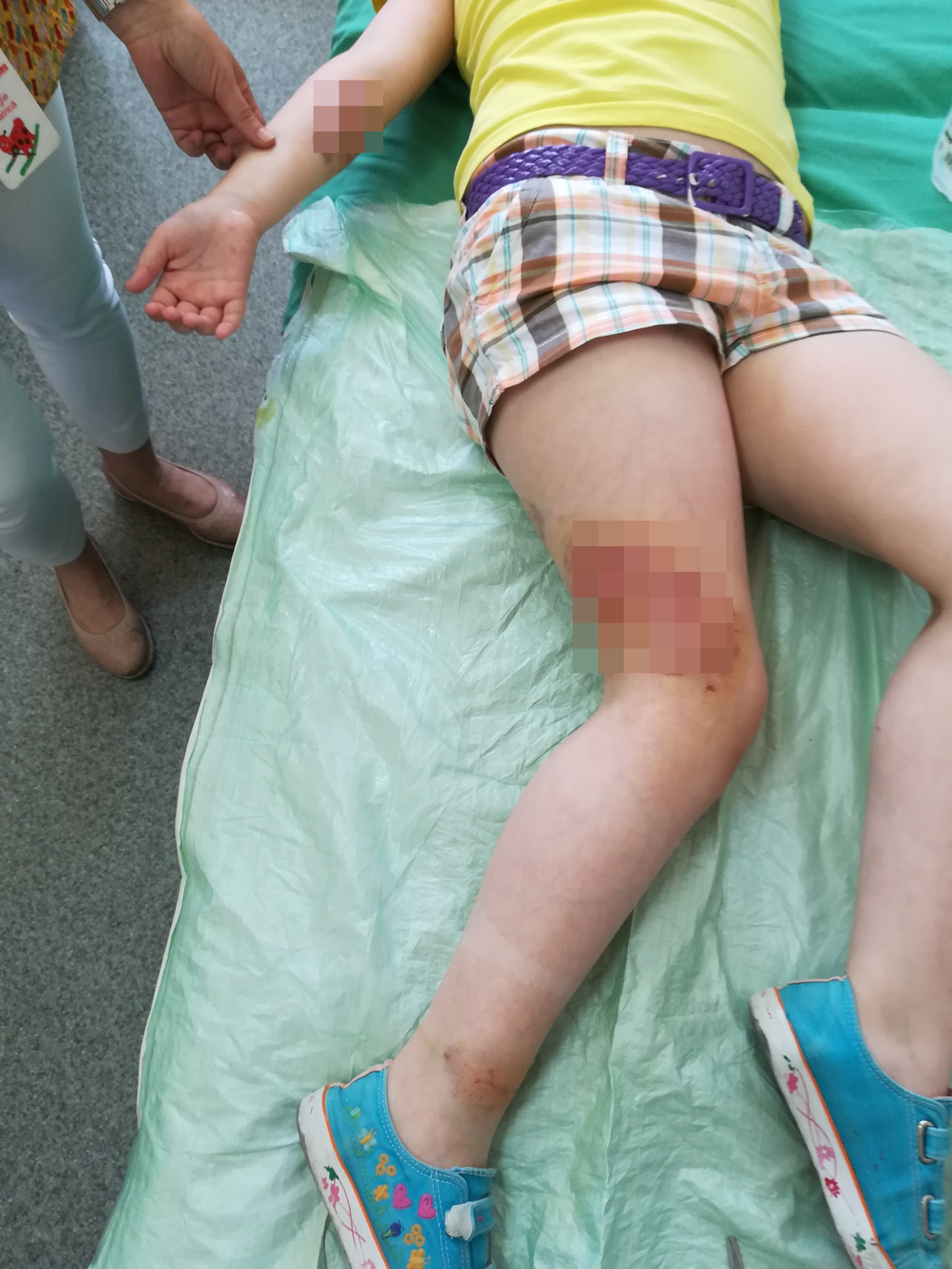 FOTO Copilă din Mediaș atacată de un maidanez - A fost mușcată de mâini, picioare și nas 3 foto copilă din mediaș atacată de un maidanez - a fost mușcată de mâini, picioare și nas